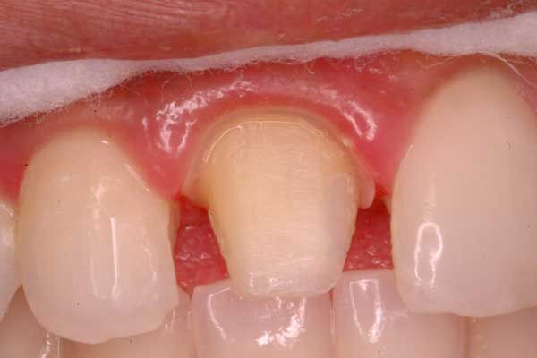 Gingival Retraction & Impression