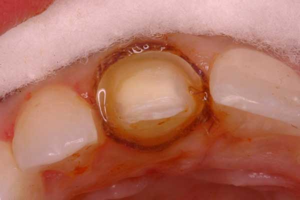 Gingival Retraction & Impression