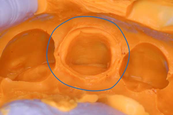 Gingival Retraction & Impression