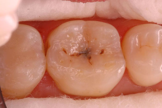 Direct Restoration Clinical Cases