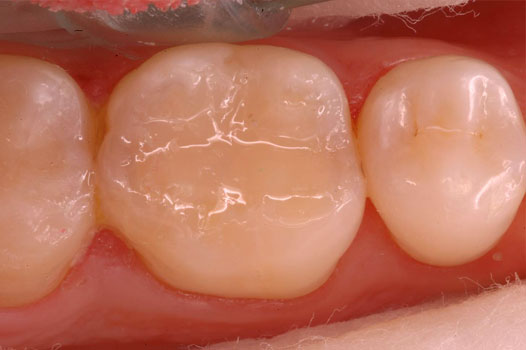 Direct Restoration Clinical Cases