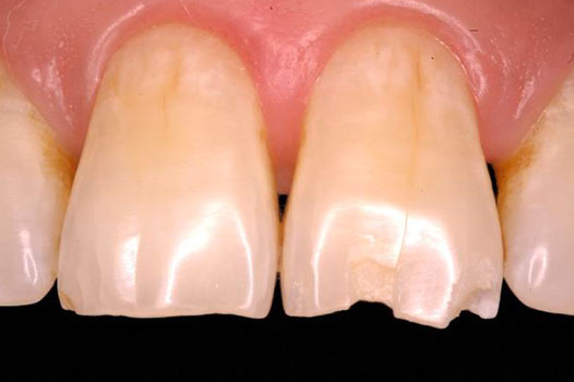Direct Restoration Clinical Cases