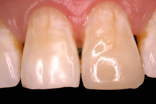 Direct Restoration Clinical Cases