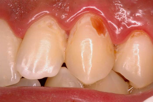 Direct Restoration Clinical Cases