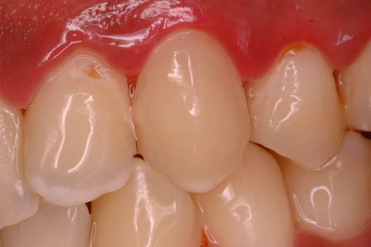 Direct Restoration Clinical Cases