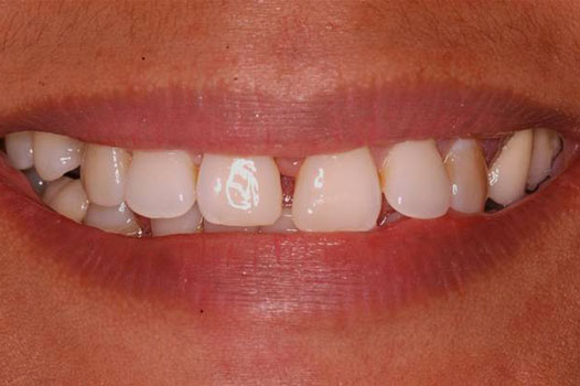 Direct Restoration Clinical Cases