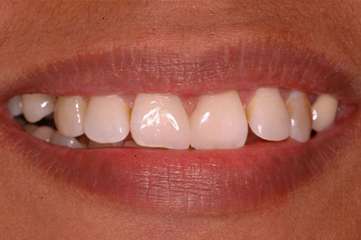 Direct Restoration Clinical Cases