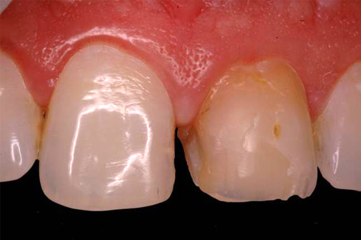 Direct Restoration Clinical Cases