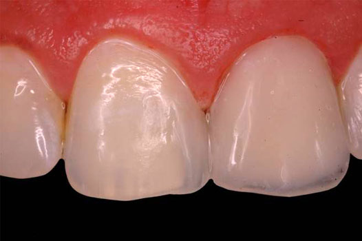 Direct Restoration Clinical Cases