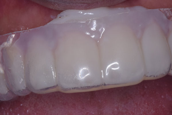 Smile Design and Treatment Planning