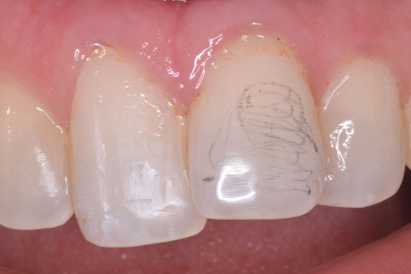 Smile Design and Treatment Planning