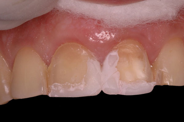 Smile Design and Treatment Planning