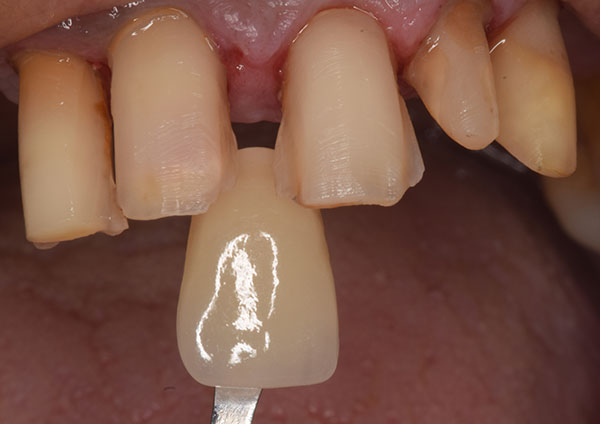 Smile Design and Treatment Planning
