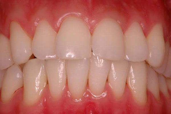 Smile Design and Treatment Planning