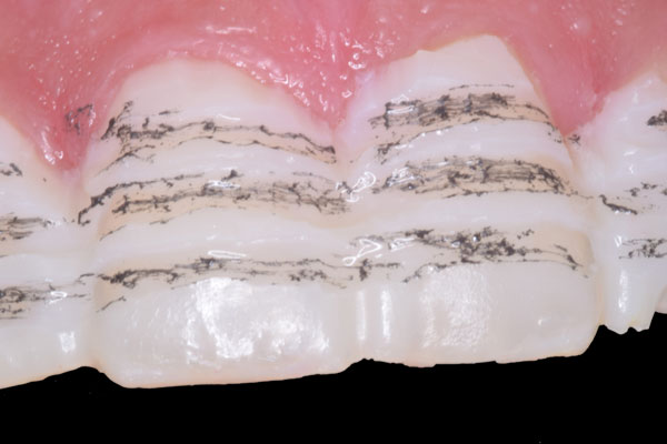 Smile Design and Treatment Planning